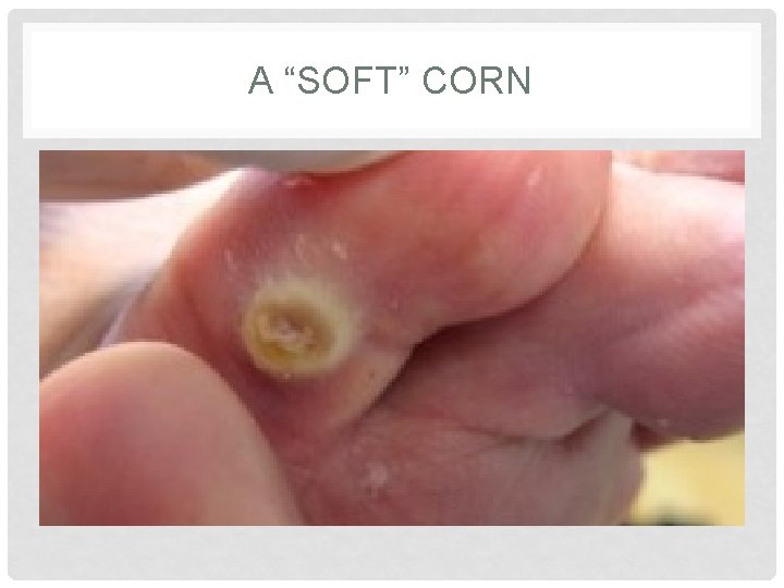 A “SOFT” CORN A “SOFT” CORN