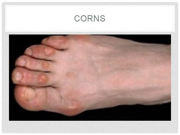 CORNS CORNS
