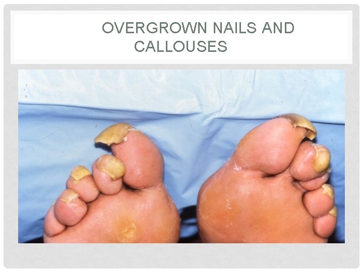 OVERGROWN NAILS AND CALLOUSES OVERGROWN NAILS AND CALLOUSES