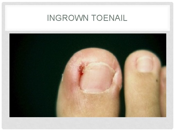 INGROWN TOENAIL INGROWN TOENAIL