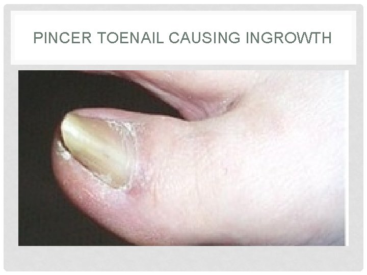 PINCER TOENAIL CAUSING INGROWTH PINCER TOENAIL CAUSING INGROWTH