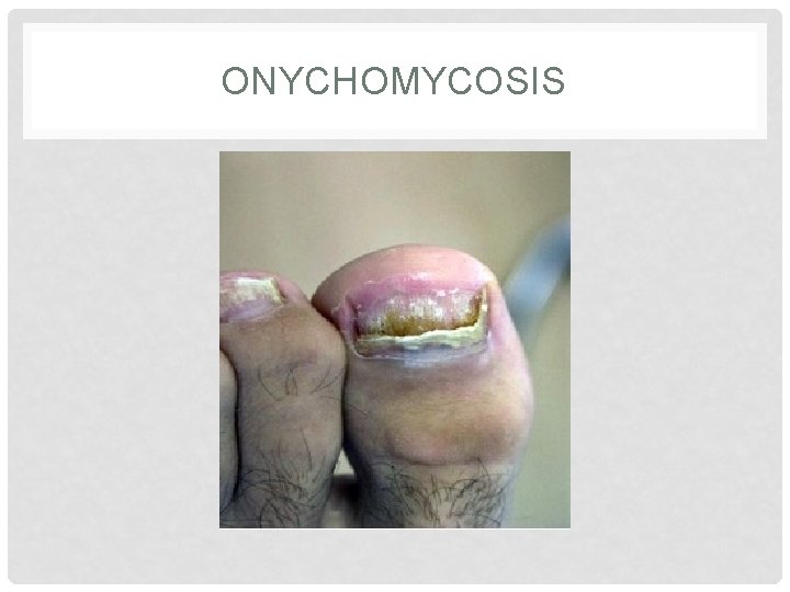 ONYCHOMYCOSIS 