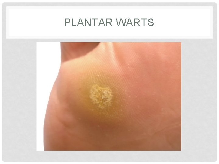 PLANTAR WARTS PLANTAR WARTS