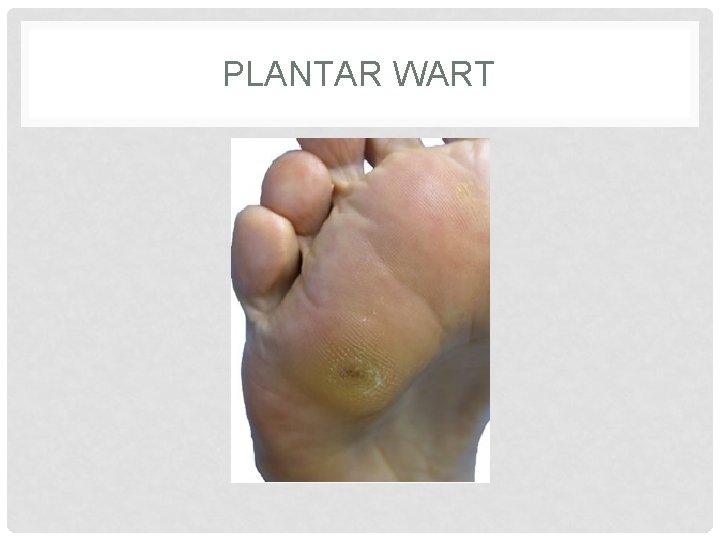 PLANTAR WART 