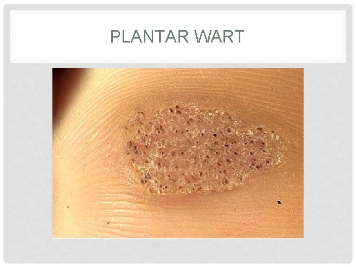 PLANTAR WART PLANTAR WART