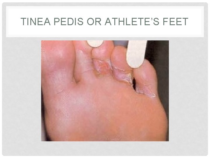 TINEA PEDIS OR ATHLETE’S FEET TINEA PEDIS OR ATHLETE’S FEET