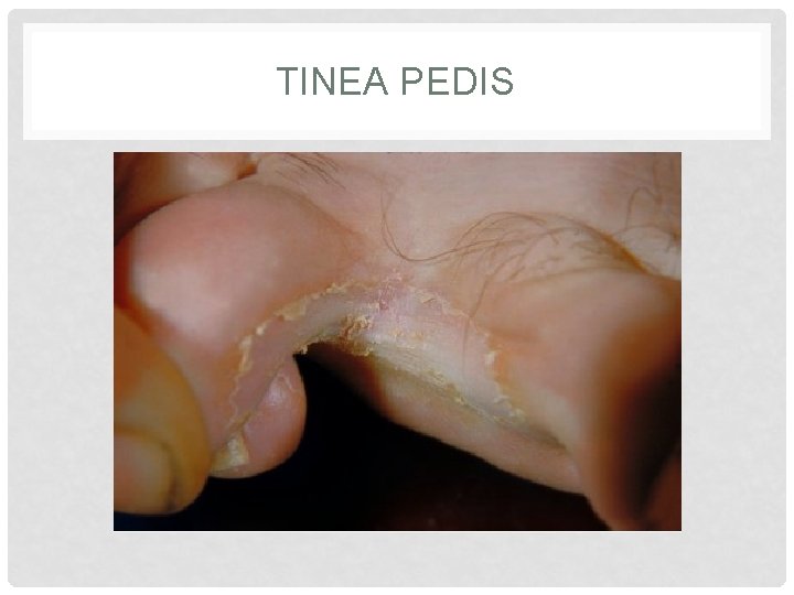 TINEA PEDIS TINEA PEDIS