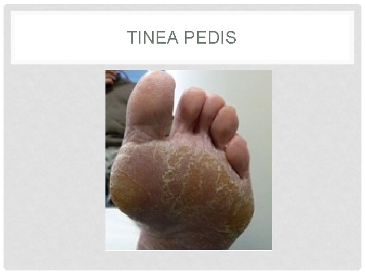 TINEA PEDIS TINEA PEDIS