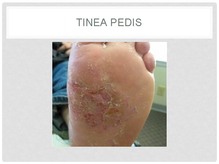 TINEA PEDIS TINEA PEDIS