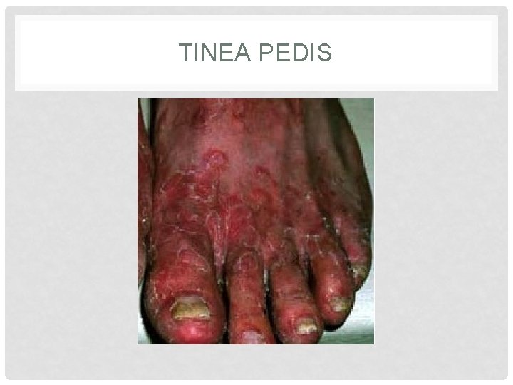 TINEA PEDIS 