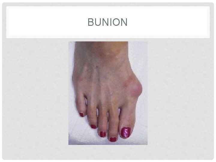 BUNION 