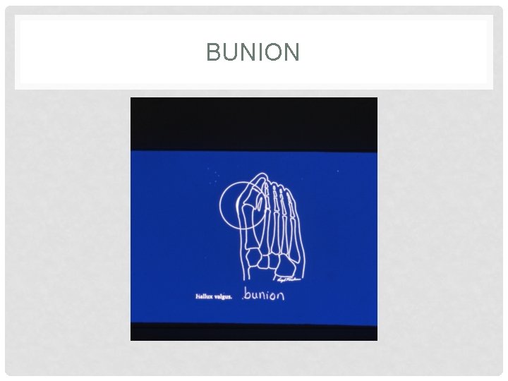 BUNION 