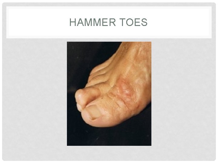 HAMMER TOES 