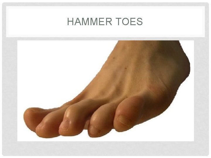 HAMMER TOES 