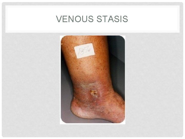 VENOUS STASIS 