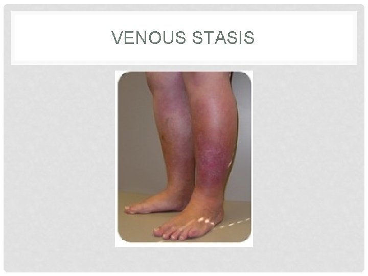 VENOUS STASIS VENOUS STASIS