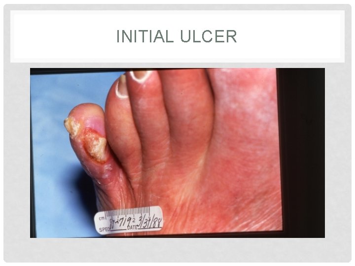 INITIAL ULCER 