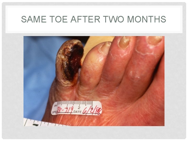 SAME TOE AFTER TWO MONTHS 