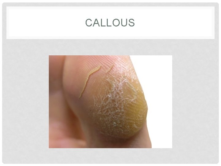 CALLOUS 