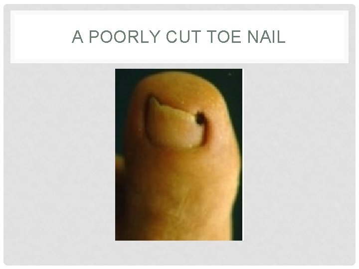 A POORLY CUT TOE NAIL 