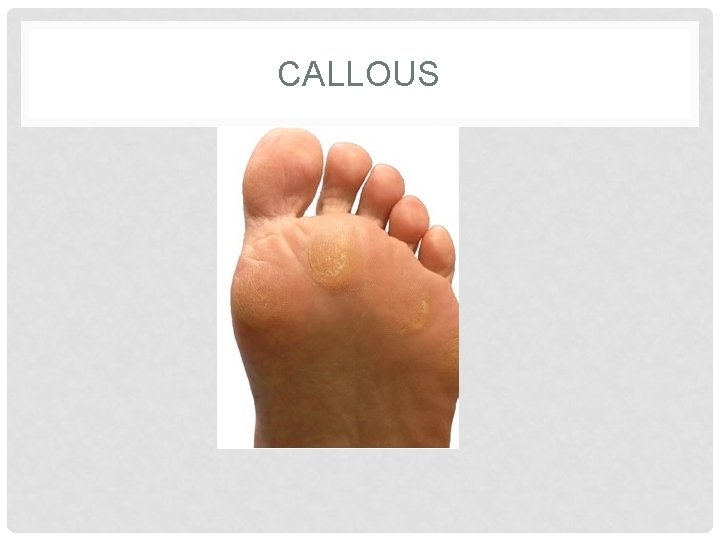 CALLOUS 