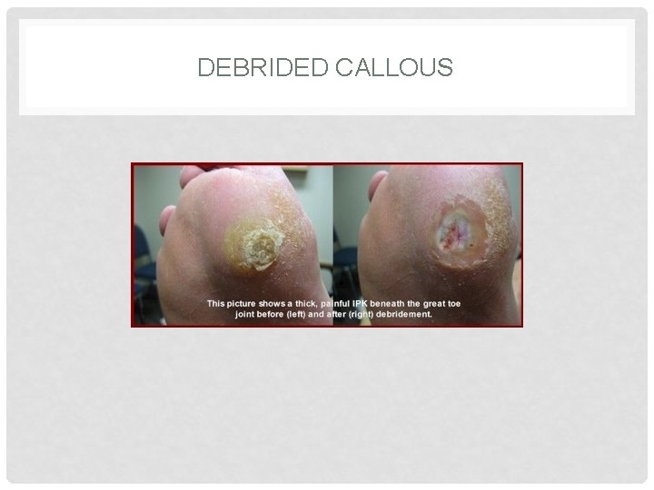 DEBRIDED CALLOUS 