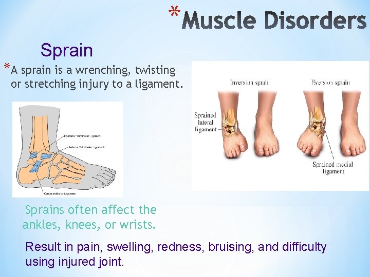 * Sprain *A sprain is a wrenching, twisting or stretching injury to a ligament.