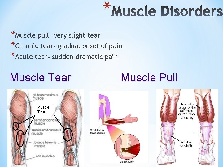 * *Muscle pull- very slight tear *Chronic tear- gradual onset of pain *Acute tear-