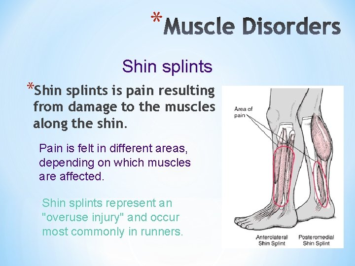 * Shin splints *Shin splints is pain resulting from damage to the muscles along