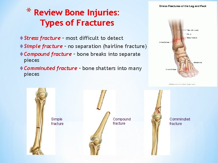 * Review Bone Injuries: Types of Fractures t Stress fracture – most difficult to