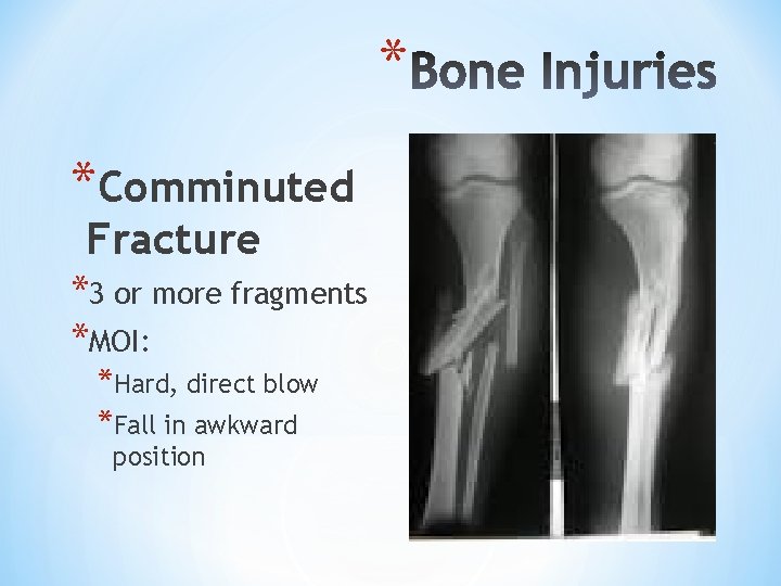 * *Comminuted Fracture *3 or more fragments *MOI: *Hard, direct blow *Fall in awkward