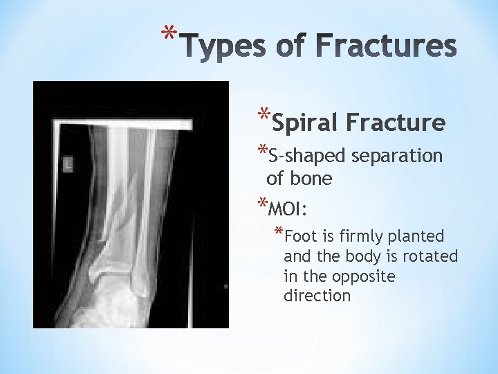 * *Spiral Fracture *S-shaped separation of bone *MOI: *Foot is firmly planted and the