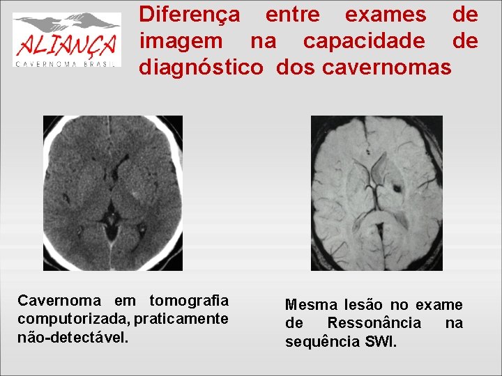 Diferença entre exames de imagem na capacidade de diagnóstico dos cavernomas Cavernoma em tomografia