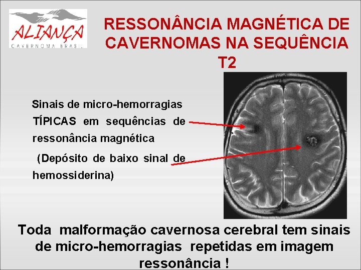 RESSON NCIA MAGNÉTICA DE CAVERNOMAS NA SEQUÊNCIA T 2 Sinais de micro-hemorragias TÍPICAS em