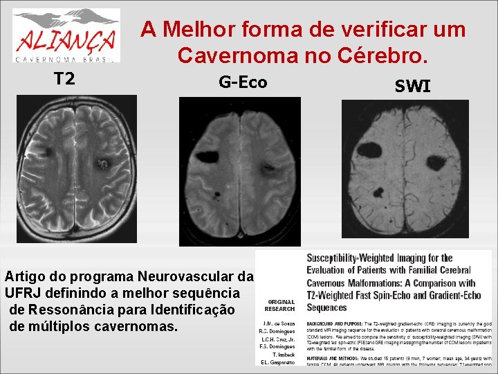 T 2 A Melhor forma de verificar um Cavernoma no Cérebro. G-Eco Artigo do