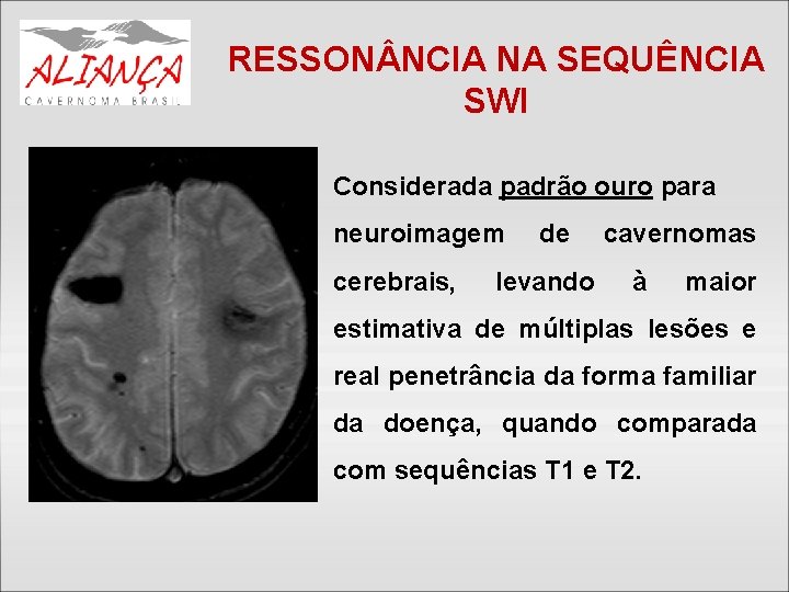 RESSON NCIA NA SEQUÊNCIA SWI Considerada padrão ouro para neuroimagem cerebrais, de levando cavernomas