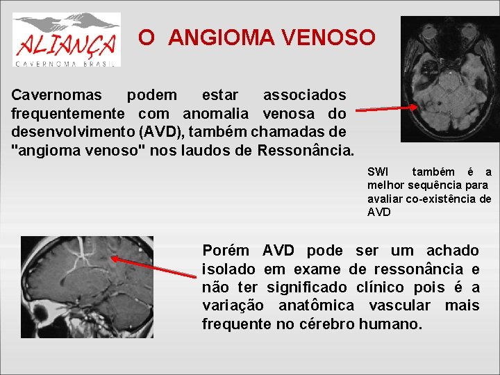 O ANGIOMA VENOSO Cavernomas podem estar associados frequentemente com anomalia venosa do desenvolvimento (AVD),