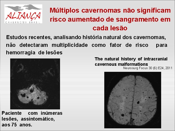 Múltiplos cavernomas não significam risco aumentado de sangramento em cada lesão Estudos recentes, analisando