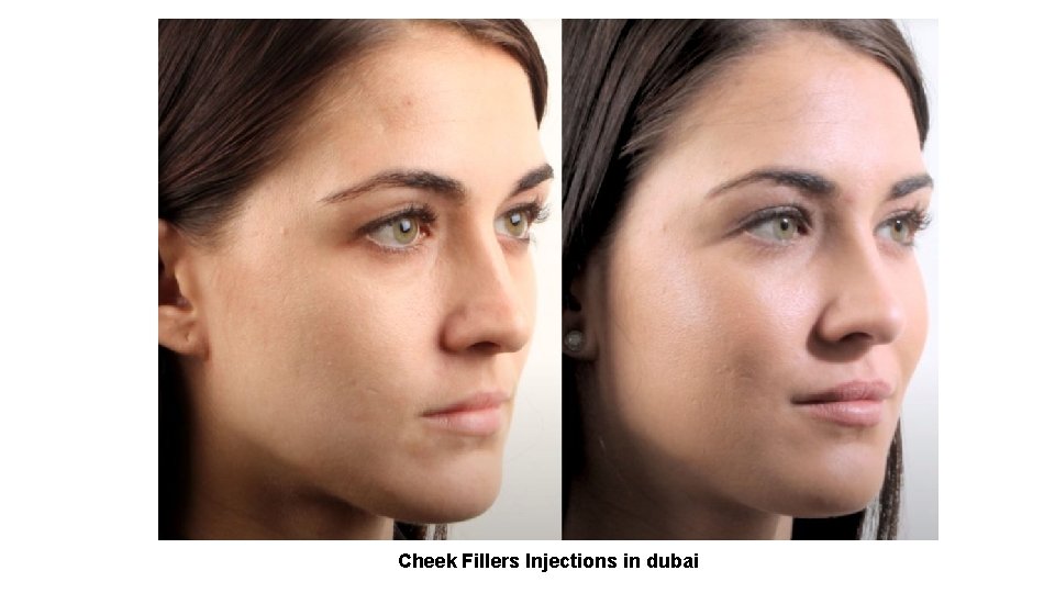 Cheek Fillers Injections in dubai 