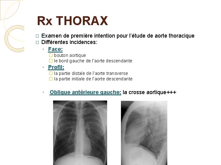 Rx THORAX � � Examen de première intention pour l’étude de aorte thoracique Différentes