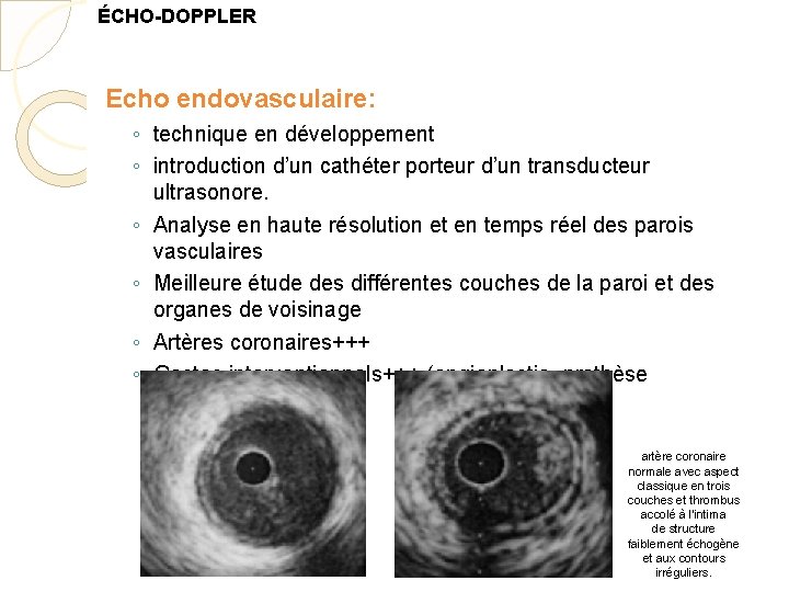 ÉCHO-DOPPLER Echo endovasculaire: ◦ technique en développement ◦ introduction d’un cathéter porteur d’un transducteur