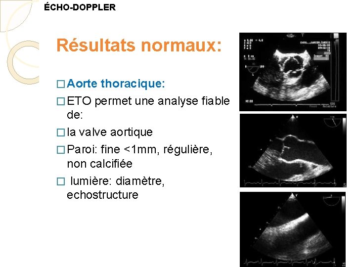 ÉCHO-DOPPLER Résultats normaux: � Aorte thoracique: � ETO permet une analyse fiable de: �