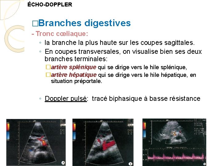 ÉCHO-DOPPLER �Branches digestives - Tronc cœliaque: ◦ la branche la plus haute sur les