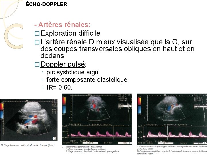 ÉCHO-DOPPLER - Artères rénales: � Exploration difficile � L’artère rénale D mieux visualisée que