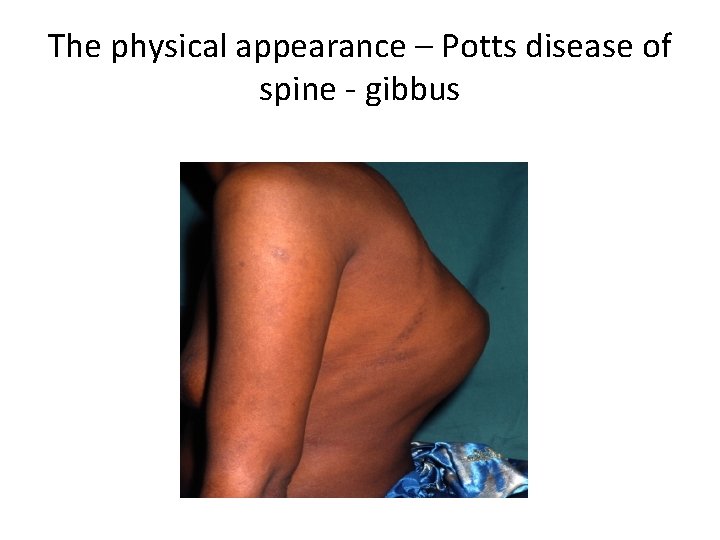 The physical appearance – Potts disease of spine - gibbus 