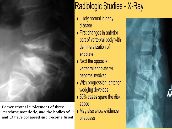 Demonstrates involvement of three vertebrae anteriorly, and the bodies of L 2 and L