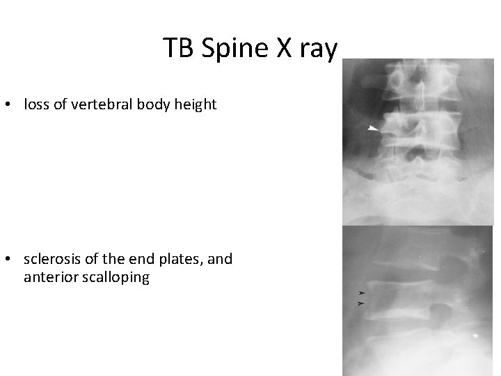 TB Spine X ray • loss of vertebral body height • sclerosis of the