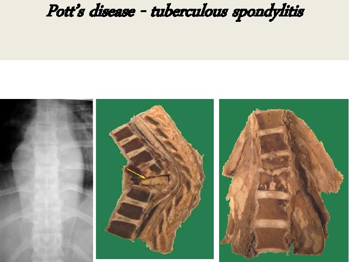 Pott’s disease - tuberculous spondylitis 