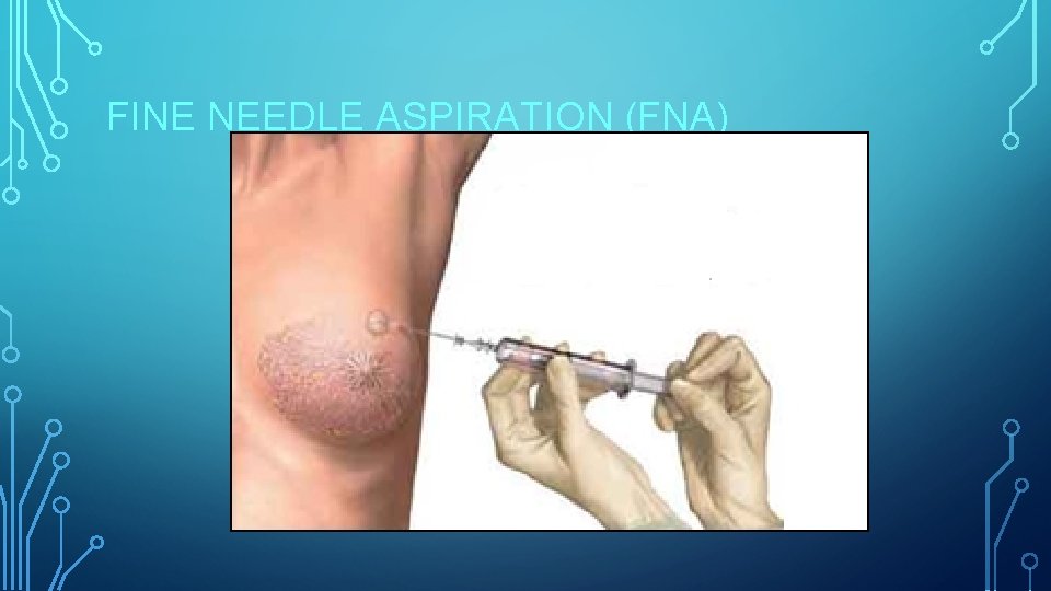 FINE NEEDLE ASPIRATION (FNA) 