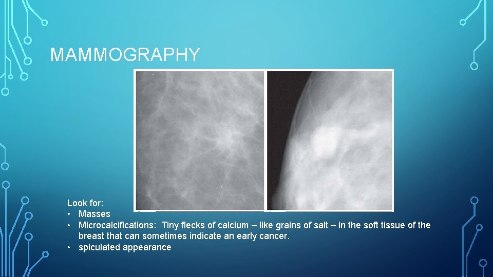 MAMMOGRAPHY Look for: • Masses • Microcalcifications: Tiny flecks of calcium – like grains